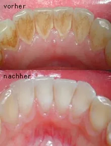 Vorher Nachher Zahnreinigung — Zahnstein und Beläge