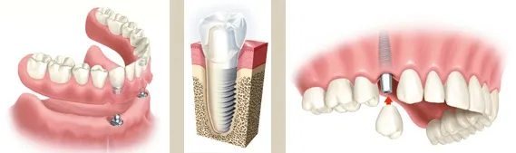 Zahnimplantat Querschnitt — Krone, Abutment, Implantat im Kieferknochen